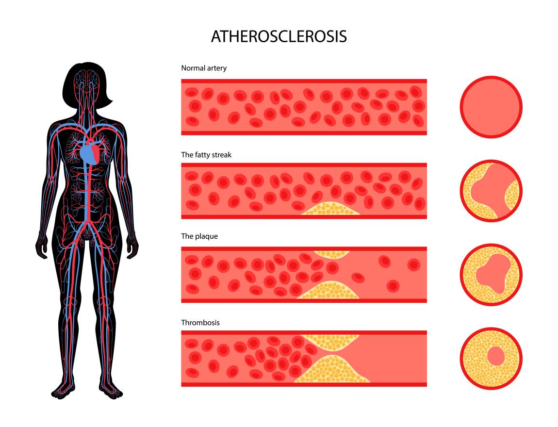 Hypercholesterolémie