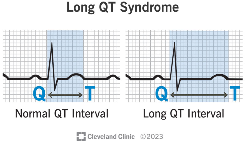 Syndrom dlouhého QT intervalu (LQTS)